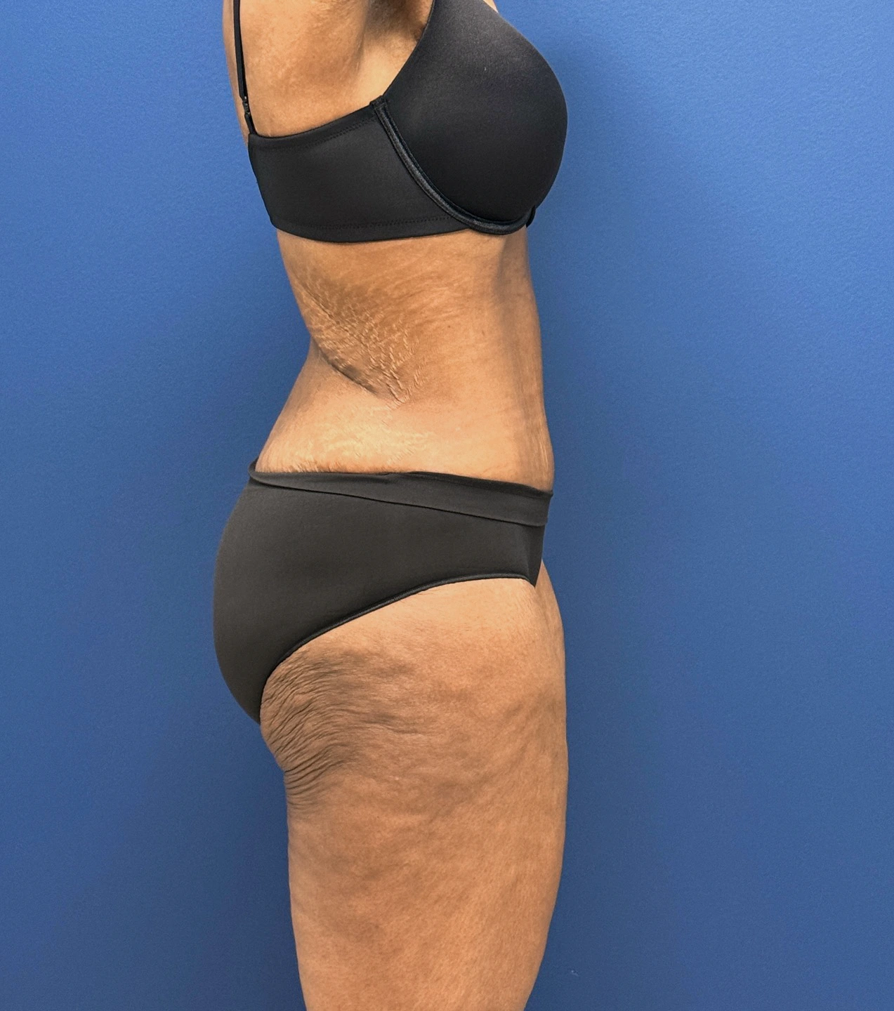 Tummy-Tuck-Case--28714 | After Tummy Tuck 4