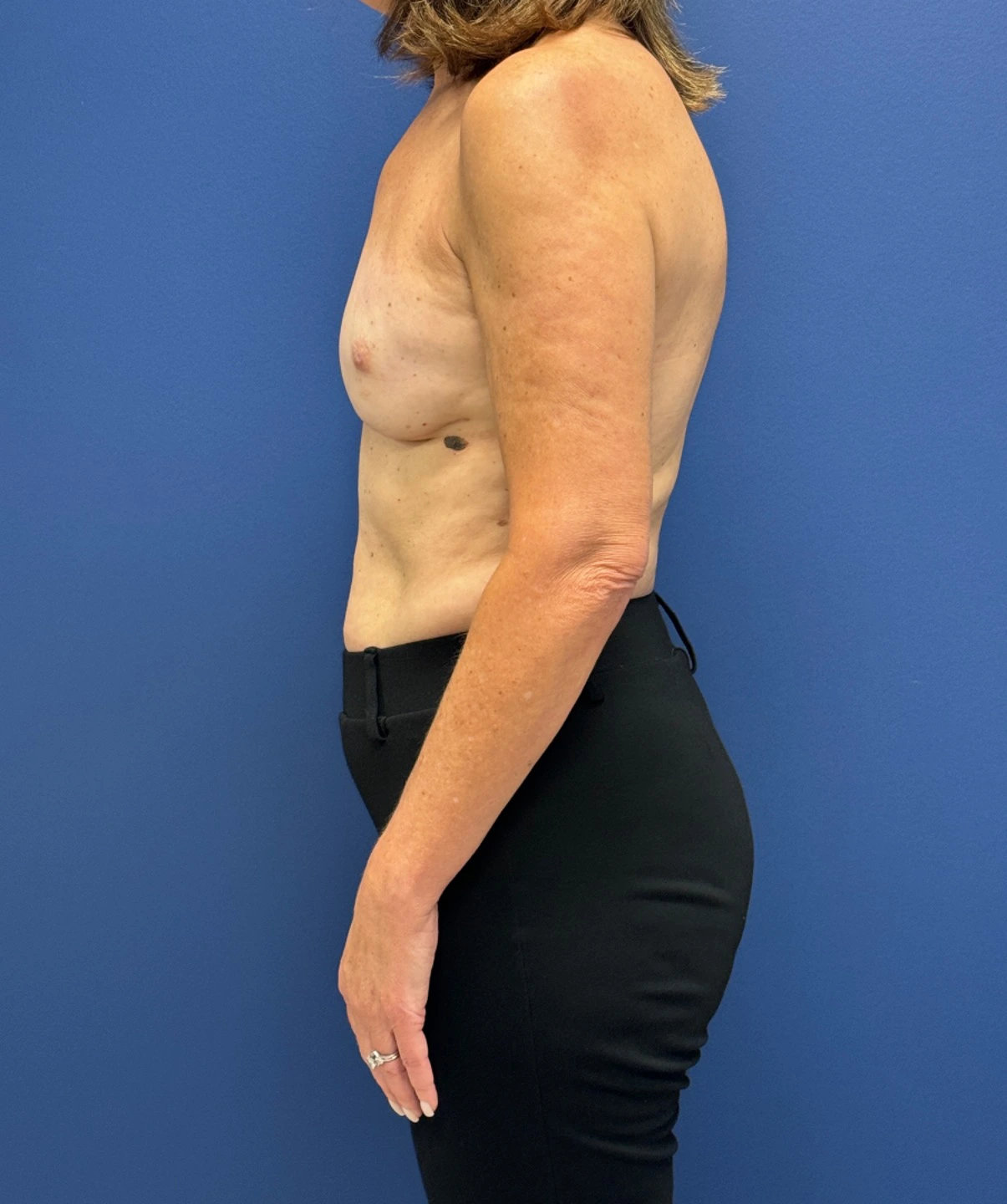 Breast-Reconstruction-Case--28688 | After Breast Reconstruction 3