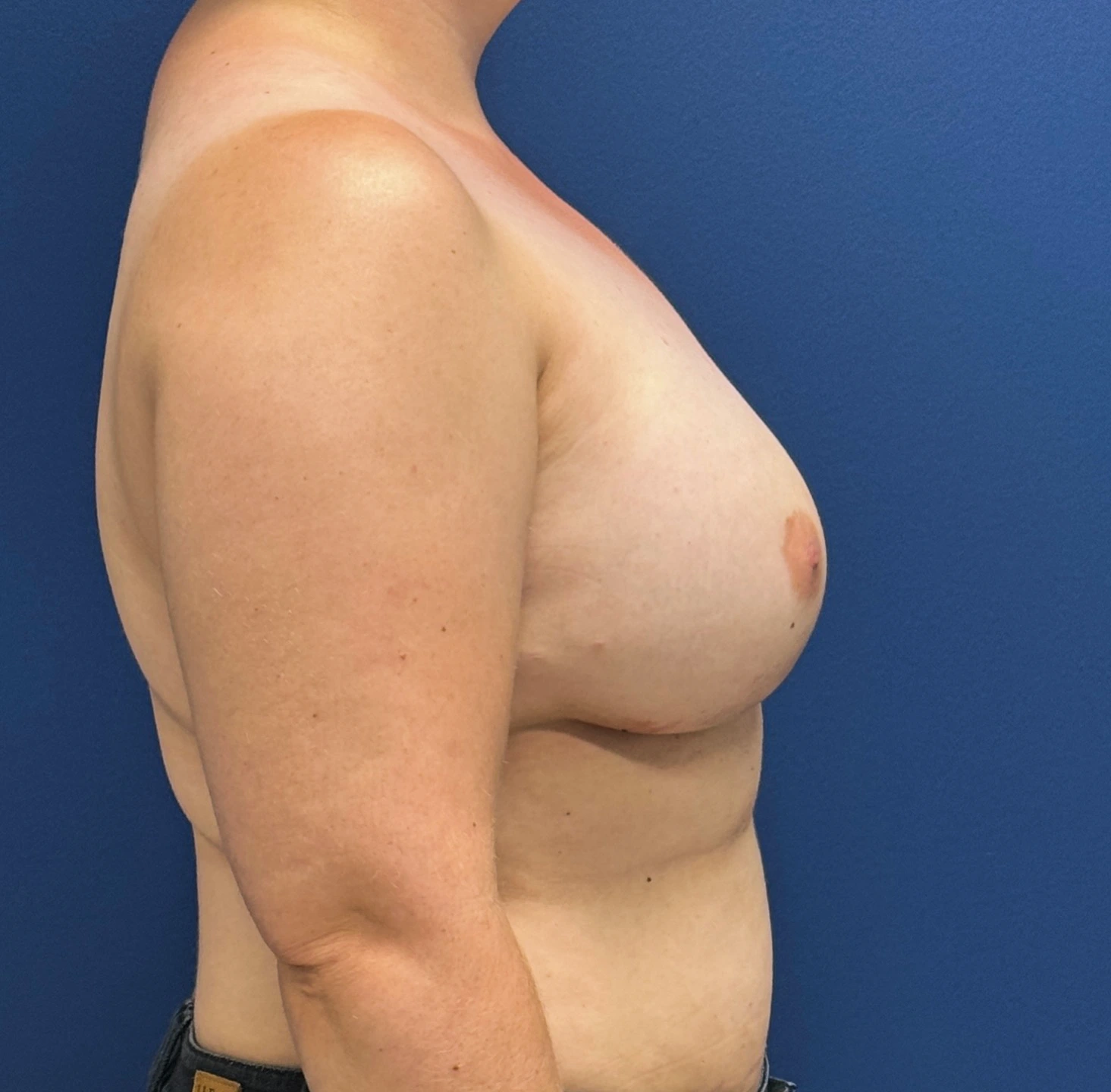 Breast-Reconstruction-Case--28689 | After Breast Reconstruction 3