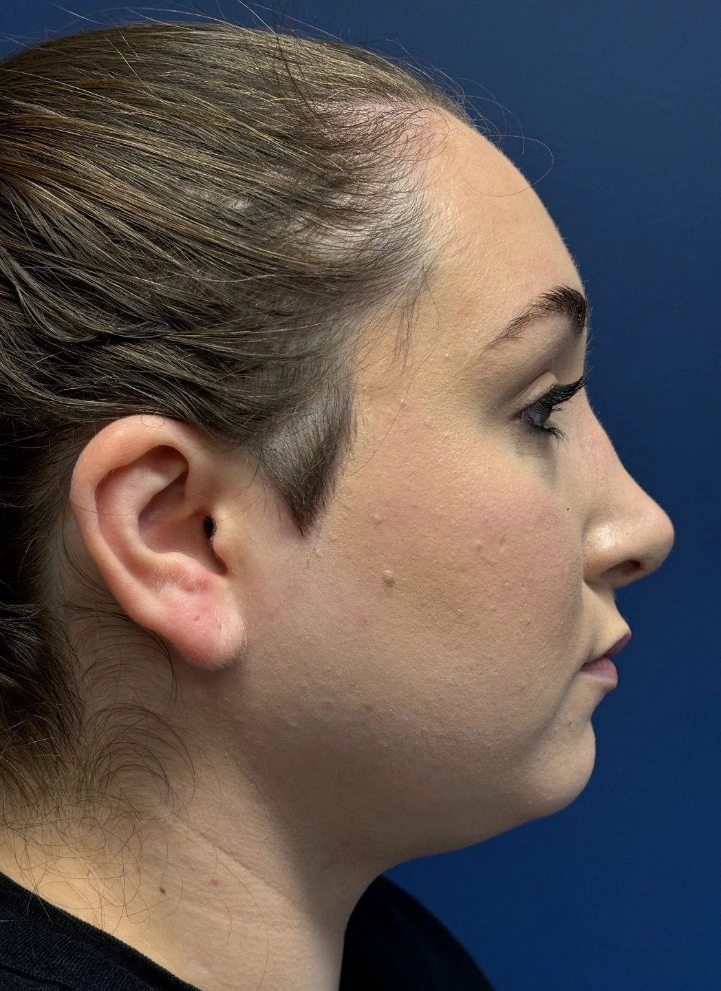 Submental-Liposuction-Case--29107 | After Submental Liposuction 5