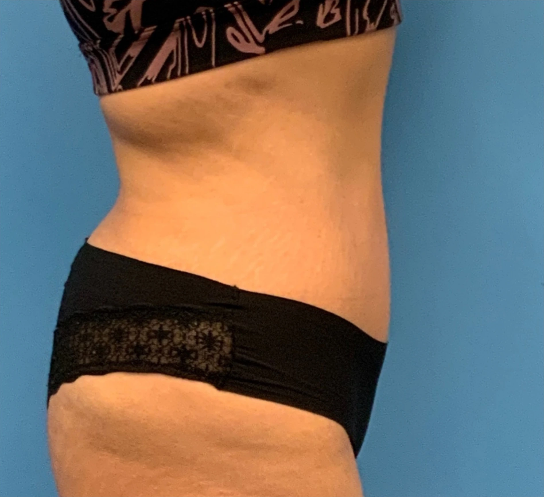 Abdominoplasty-Case--23747 | After Tummy Tuck 5