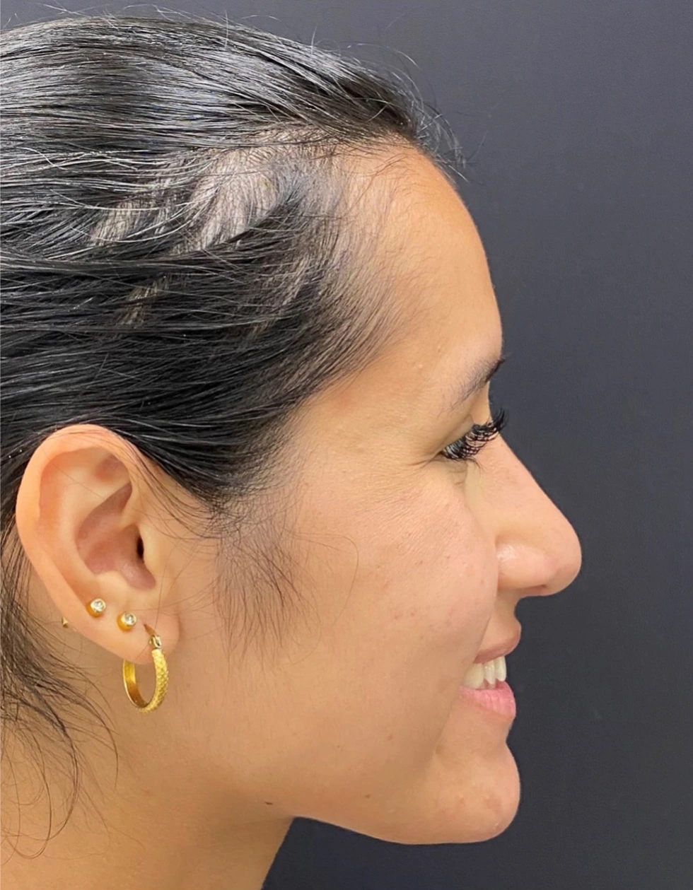 Rhinoplasty-Case--376 | After Rhinoplasty 3