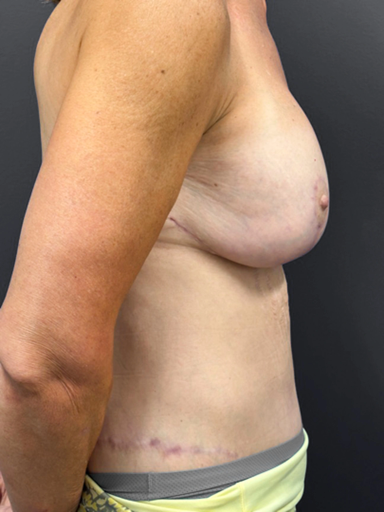 Augmentation-Mastopexy-Case--3055 | After Breast Augmentation With Lift 3