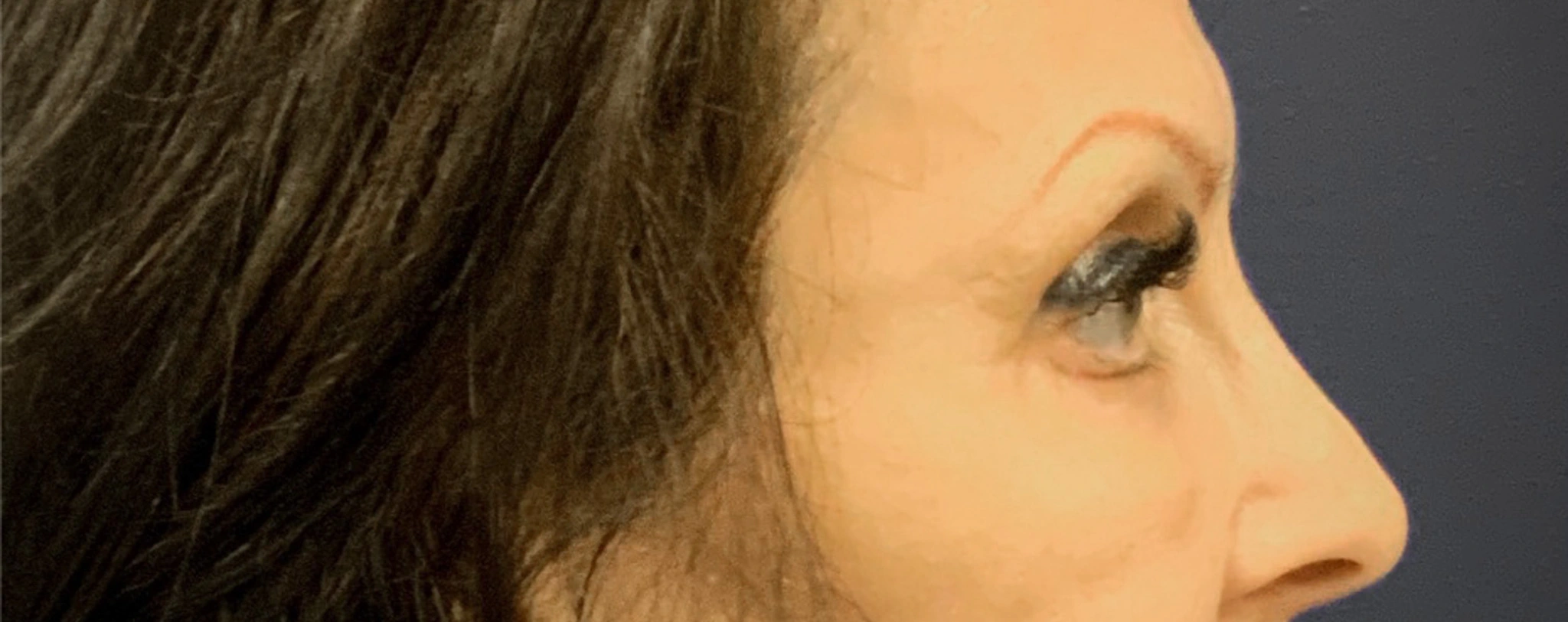Blepharoplasty-Case--6272 | After Eyelid Surgery 3