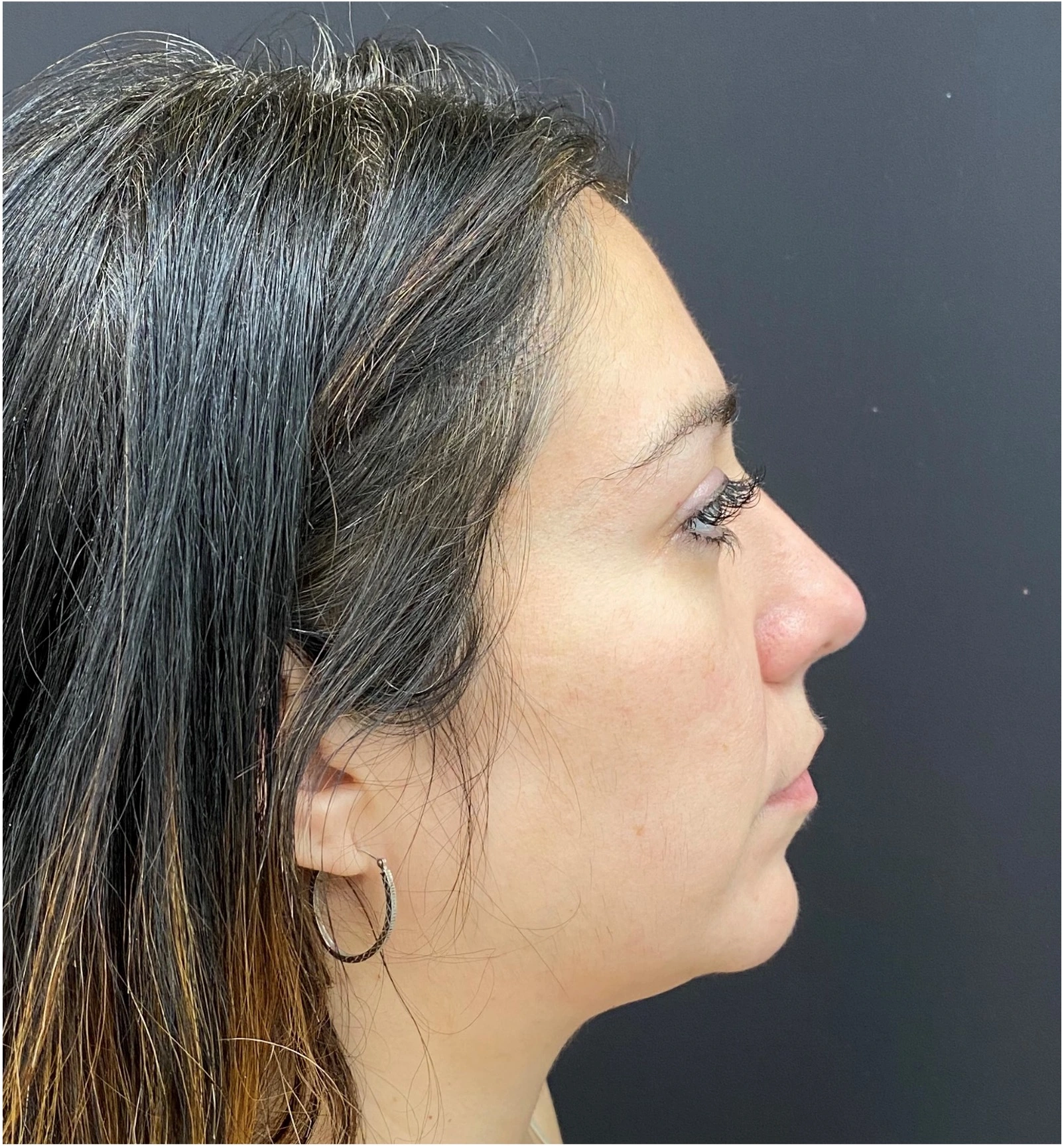 Rhinoplasty-Case--377 | After Rhinoplasty 3