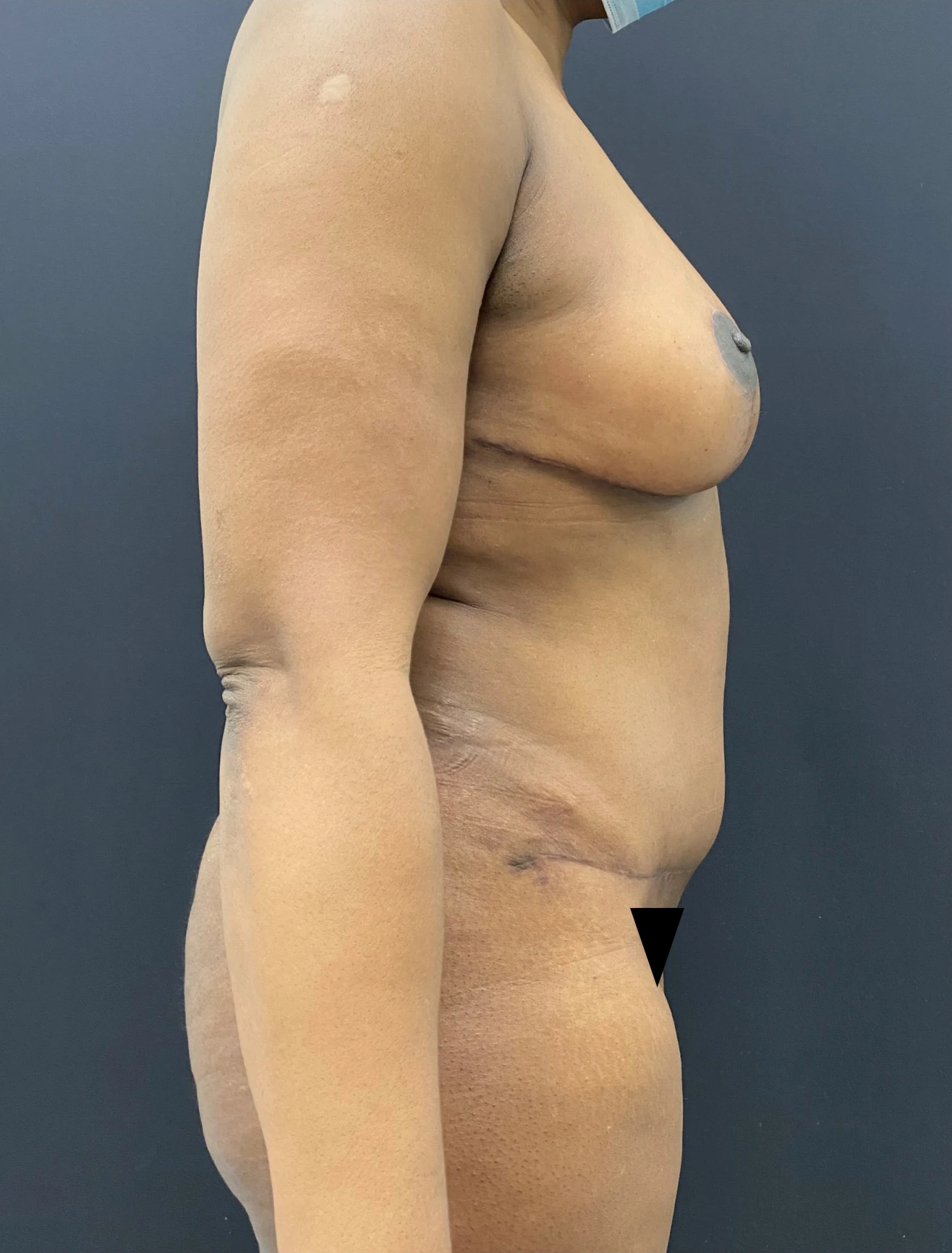 Mommy-makeover-Case--336 | After Mommy Makeover 3