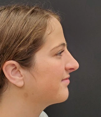 Rhinoplasty-and-Chin-Implant-Case--381 | After Rhinoplasty 4