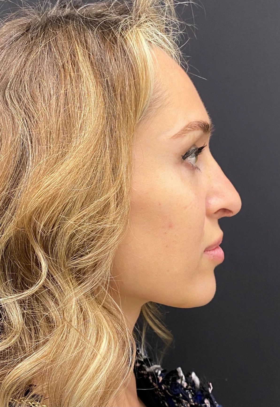 Rhinoplasty-Case--378 | After Rhinoplasty 3