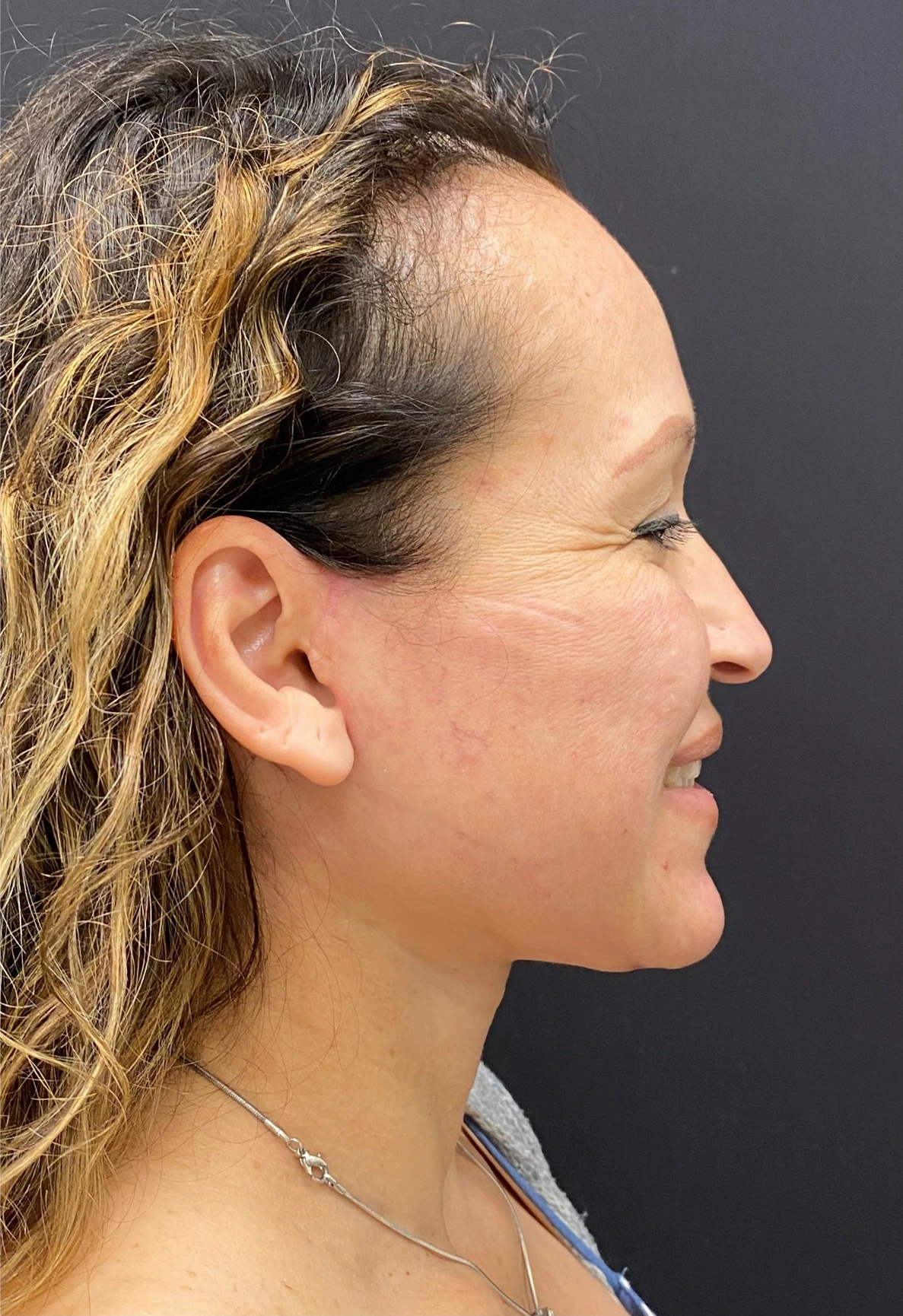 Facelift-Case--364 | After Facelift 3