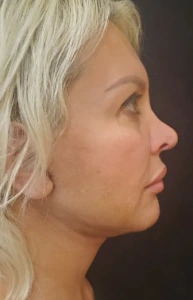 Facelift-Case--362 | After Facelift 2