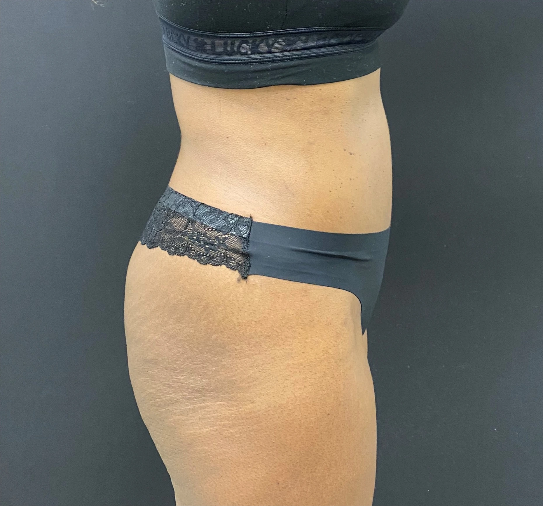 Abdominoplasty-Case--340 | After Tummy Tuck 4