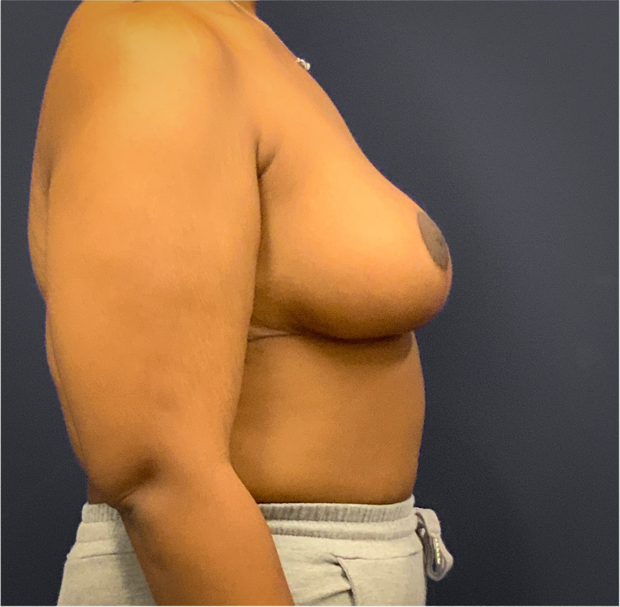 Breast-Reduction-Case--5320 | After Breast Reduction 3