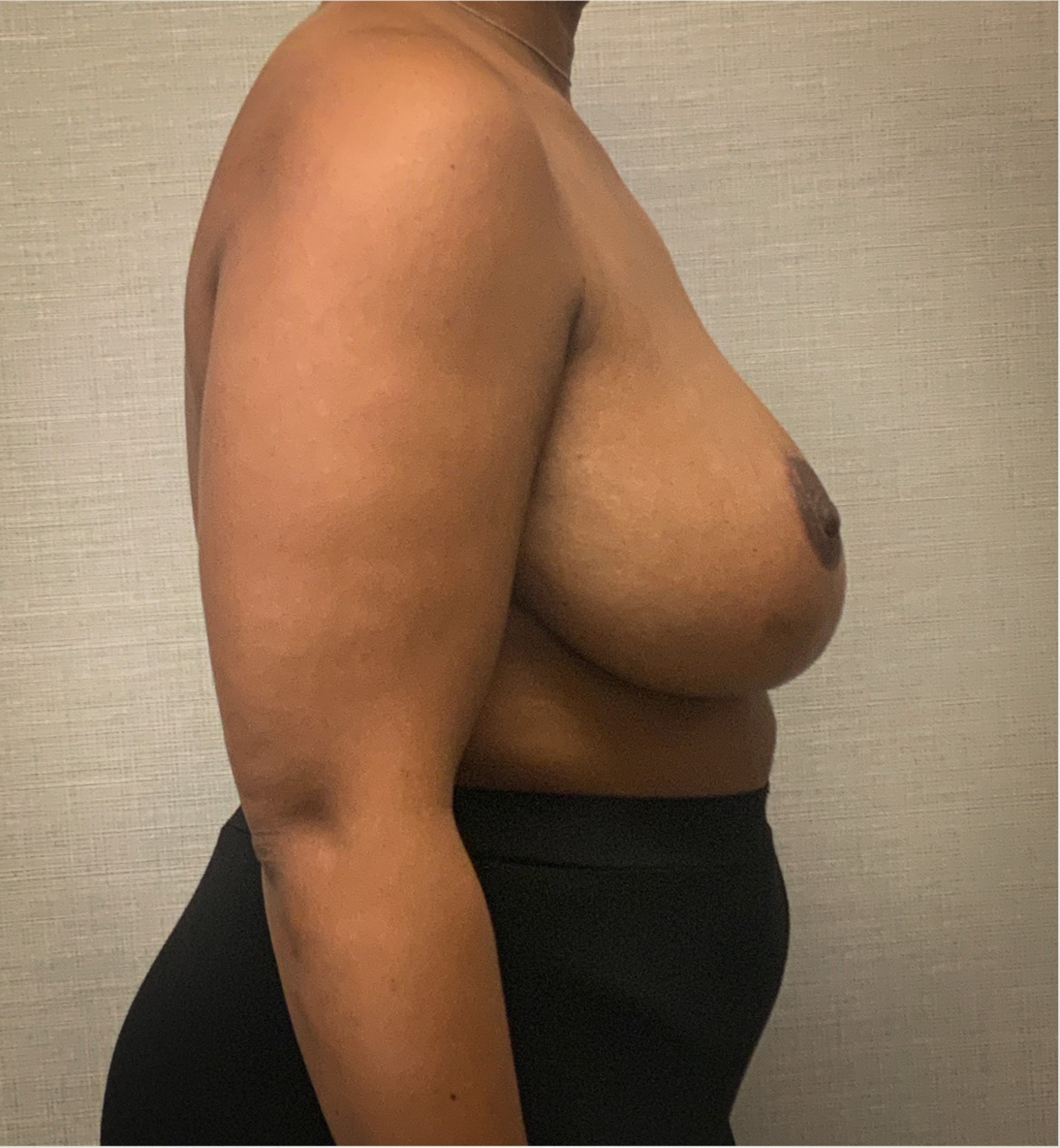 Breast-Reduction-Case--2564 | After Breast Reduction 3