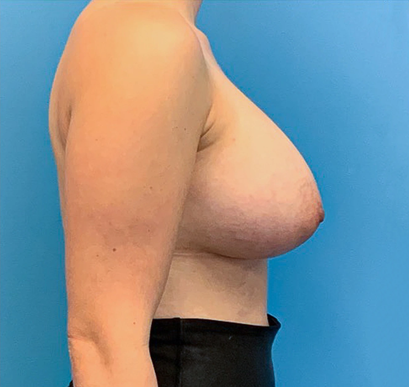 Breast-Augmentation-Case--23631 | After Breast Augmentation 5