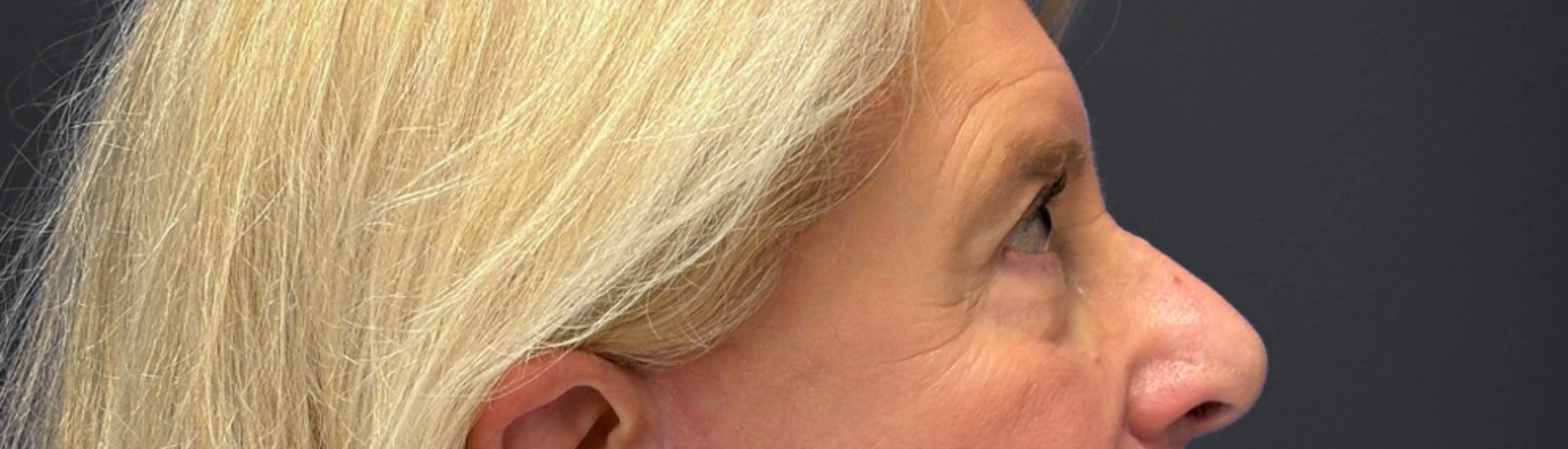 Blepharoplasty-Case--3336 | After Eyelid Surgery 3