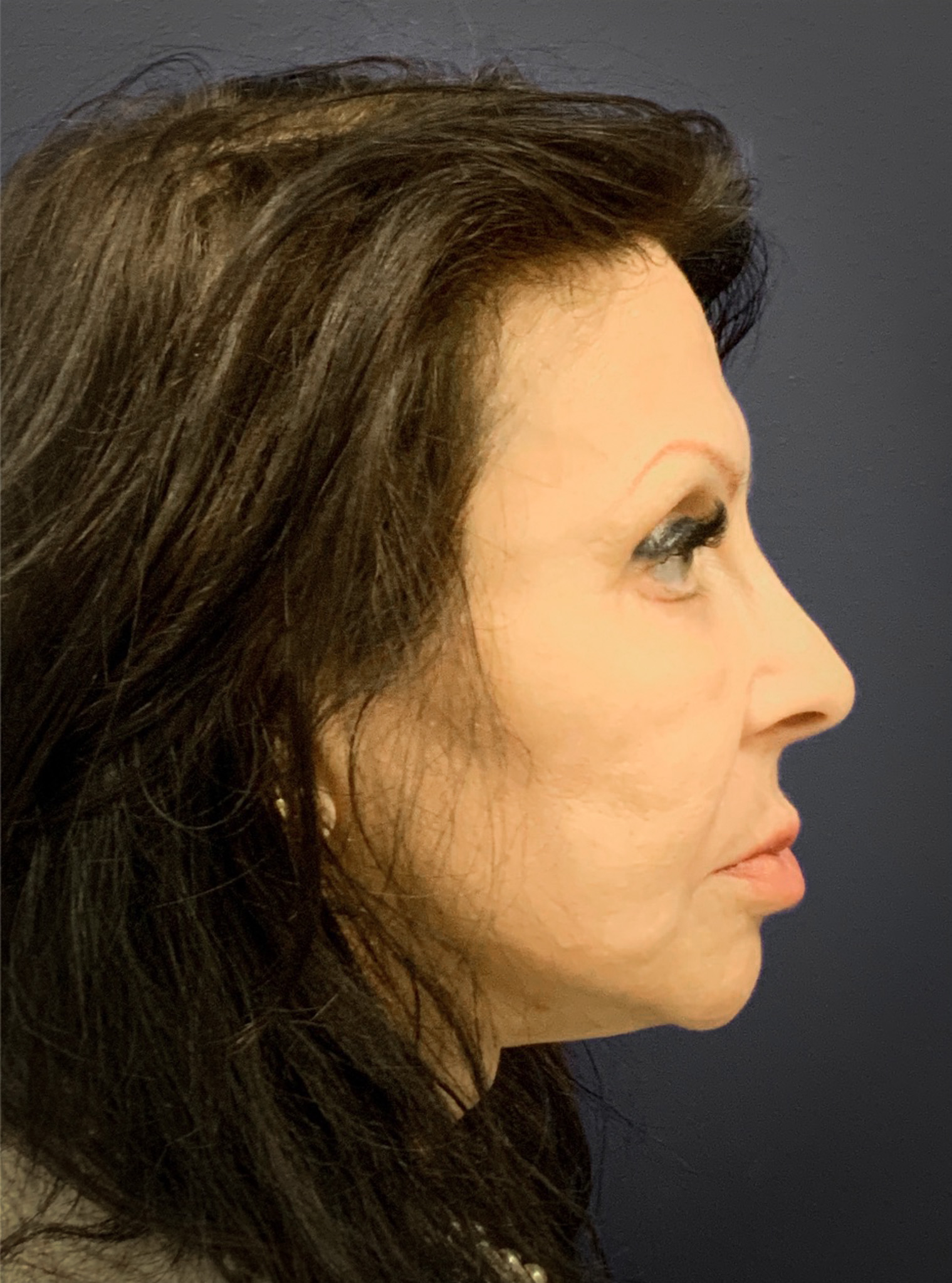 Blepharoplasty-Case--6272 | After Eyelid Surgery 4