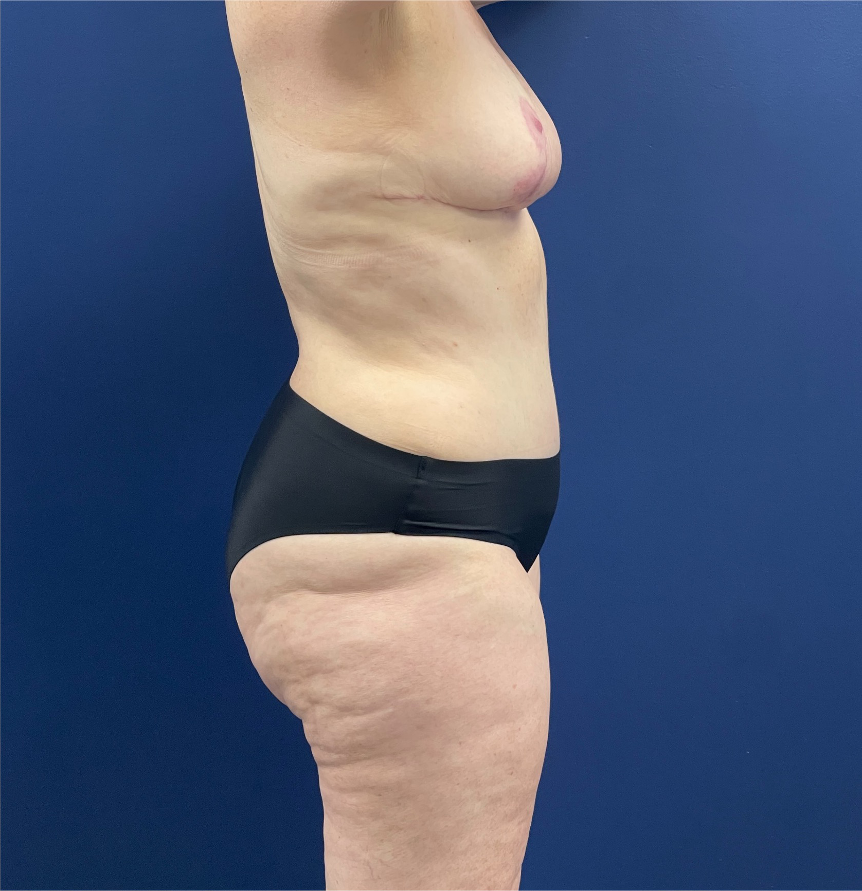 Mommy-Makeover-Case--26853 | After Mommy Makeover 3