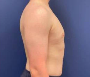 Gynecomastia-Case--214 | After Gynecomastia / Male Breast Reduction 2