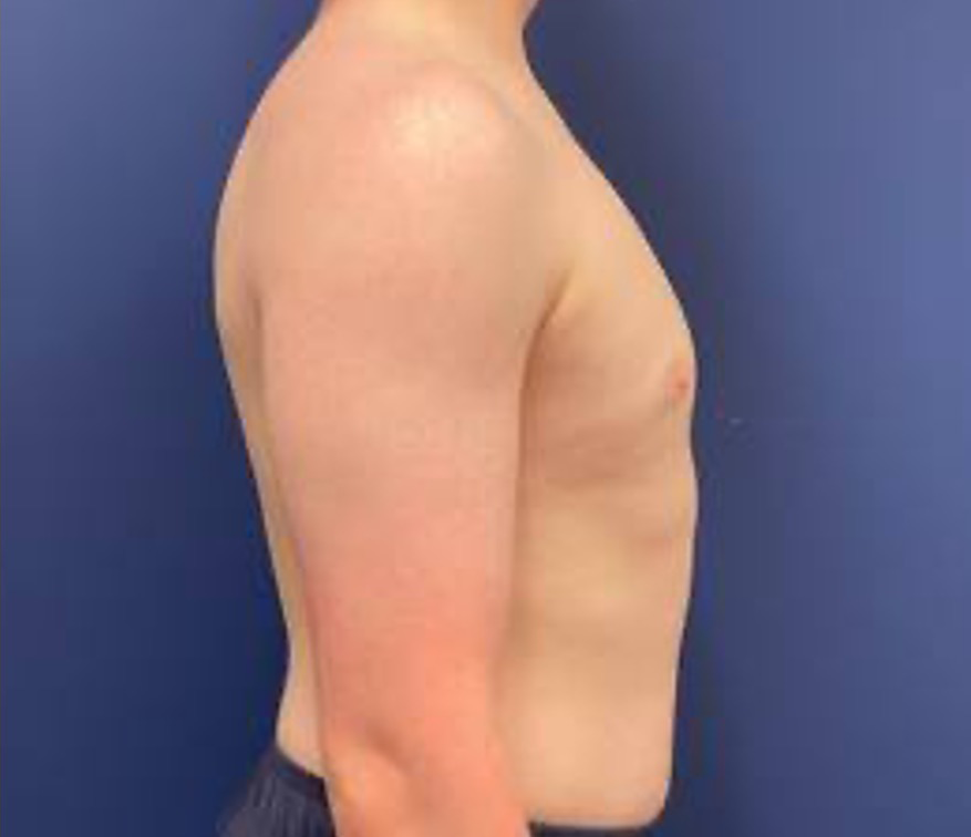Gynecomastia-Case--214 | After Gynecomastia / Male Breast Reduction 2
