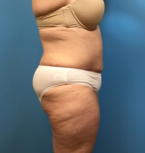 Case--249 | After Liposuction 2