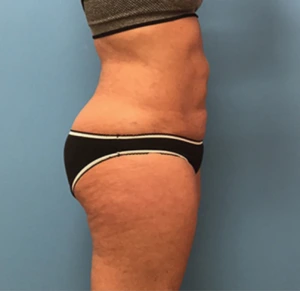 Liposuction-Case--72-1 | After Liposuction 2