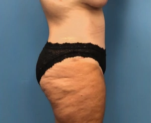 Case--252 | After Mommy Makeover 2