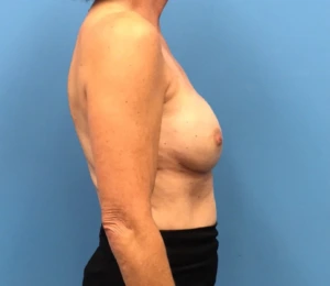 Breast-Reconstruction-Case--309 | After Dr. Samir Rao 2