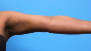 Case--279 | After Liposuction 2