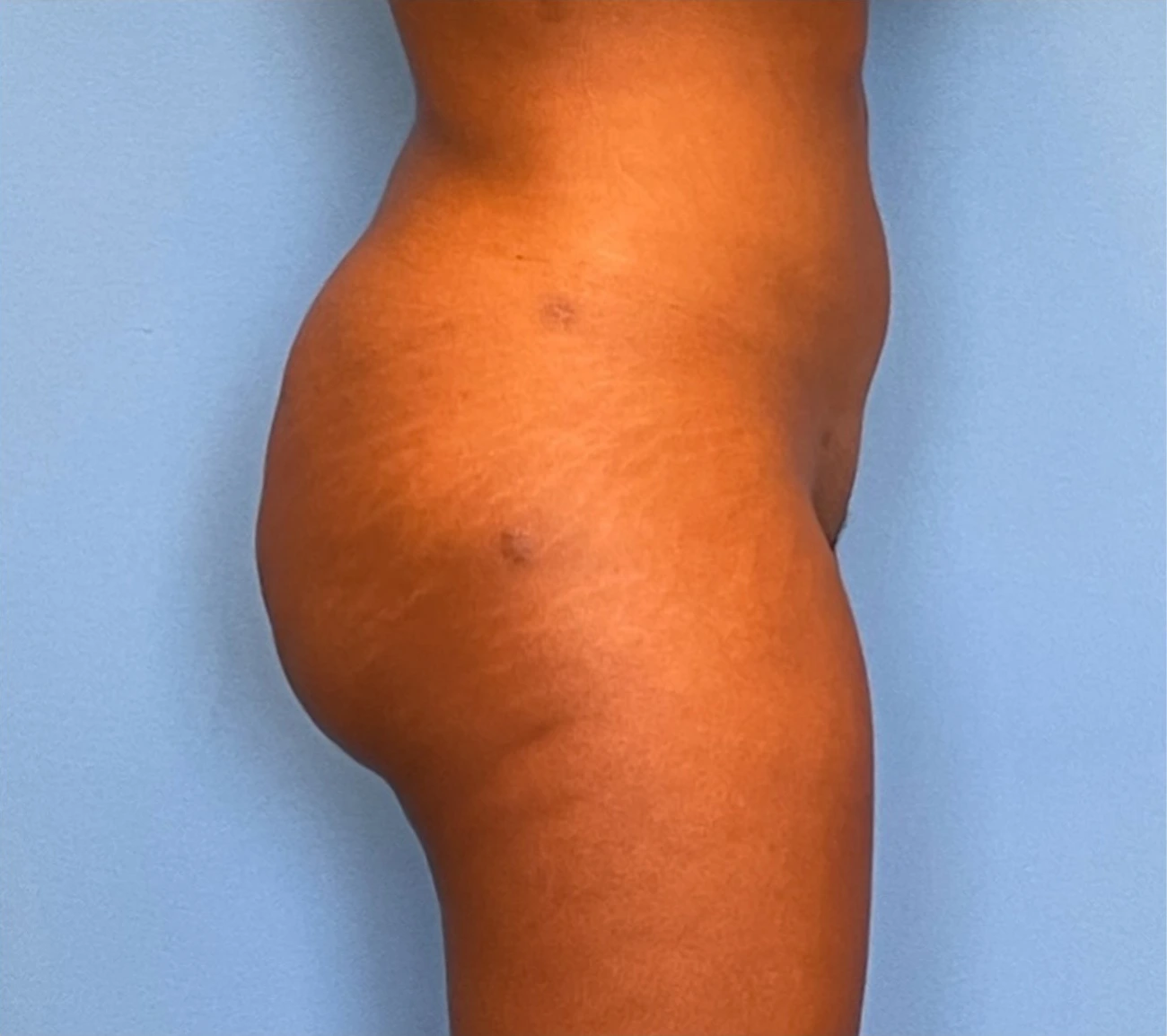 Brazilian-Butt-Lift-Case--263 | After Brazilian Butt Lift 3