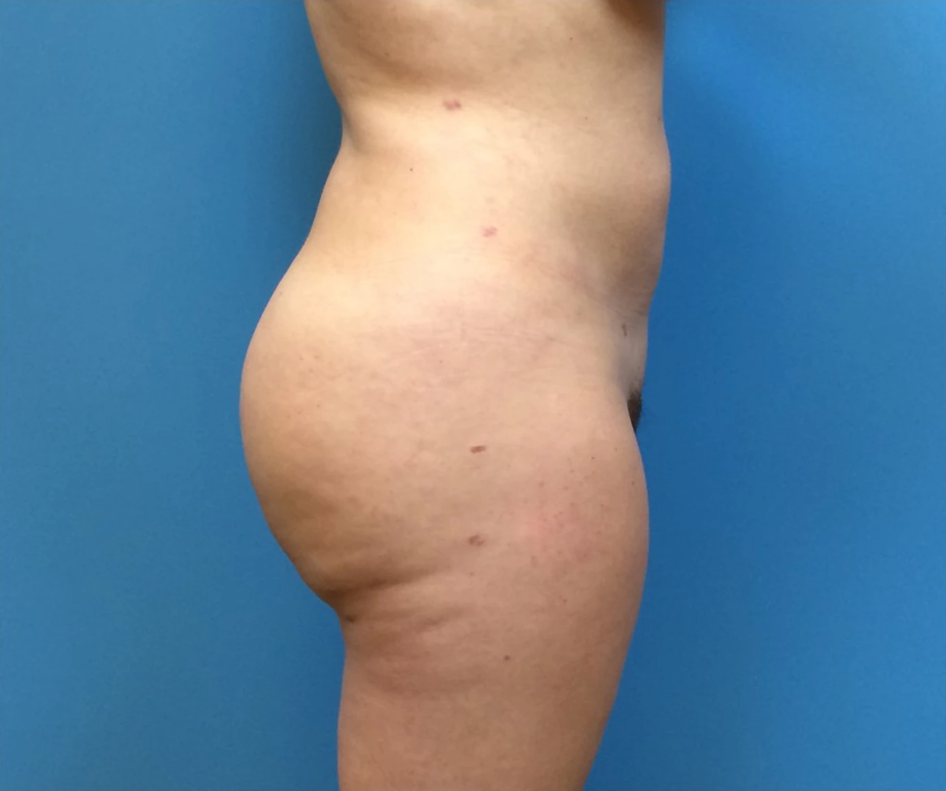 Brazilian-Butt-Lift-Case--266 | After Brazilian Butt Lift 2