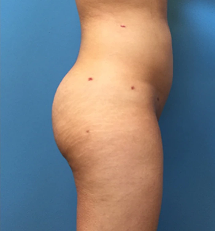 Brazilian-Butt-Lift-Case--73 | After Brazilian Butt Lift 3