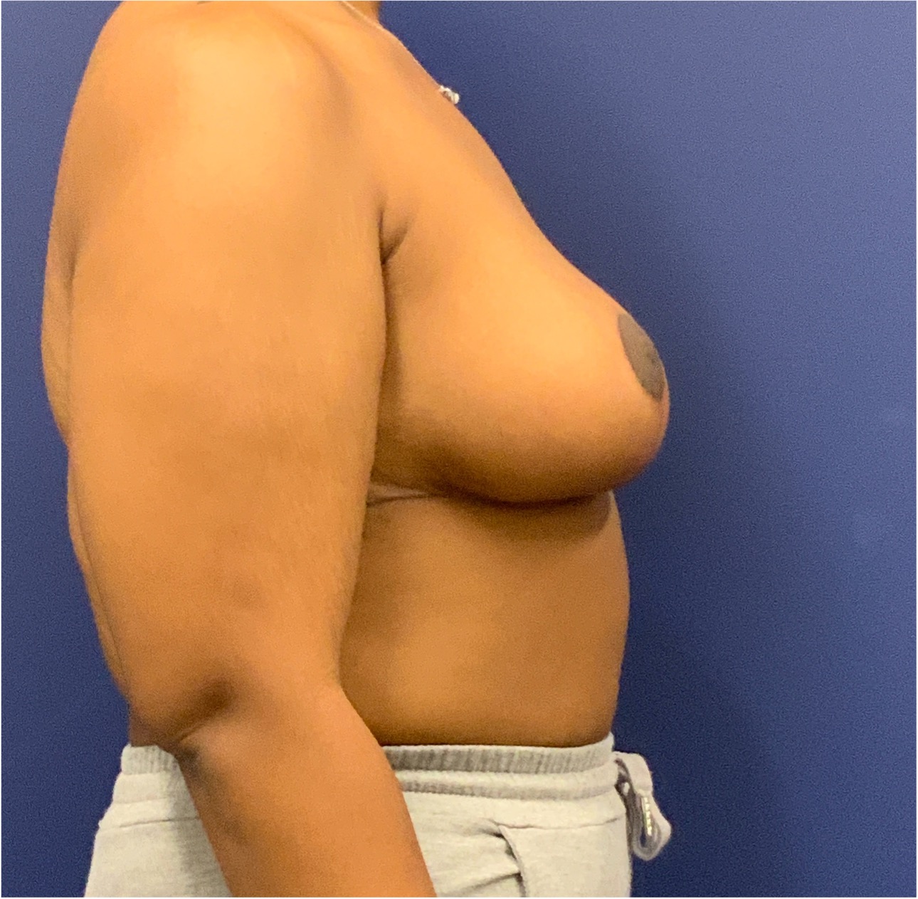 Breast-Reduction-Case--27281 | After Breast Reduction 5