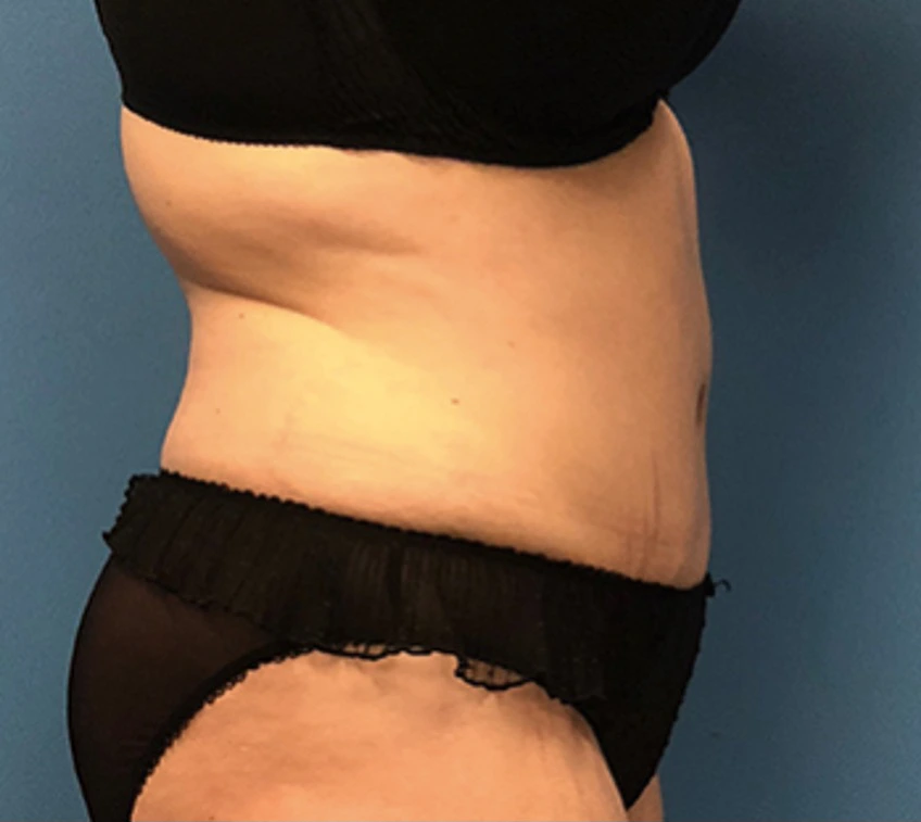 Case--56 | After Liposuction 3