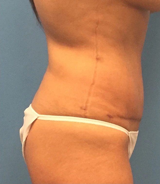 Case--65 | After Liposuction 3