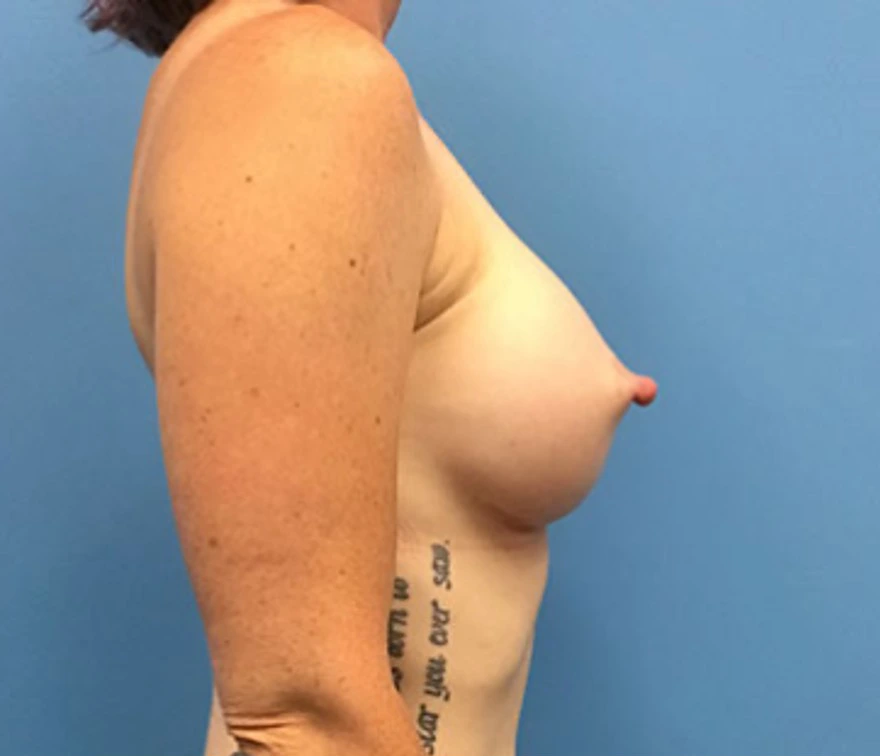 Case--88 | After Breast Augmentation 5