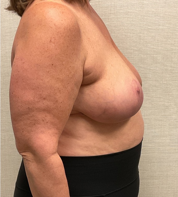 Breast-Reduction-Case--26425 | After Breast Reduction 3