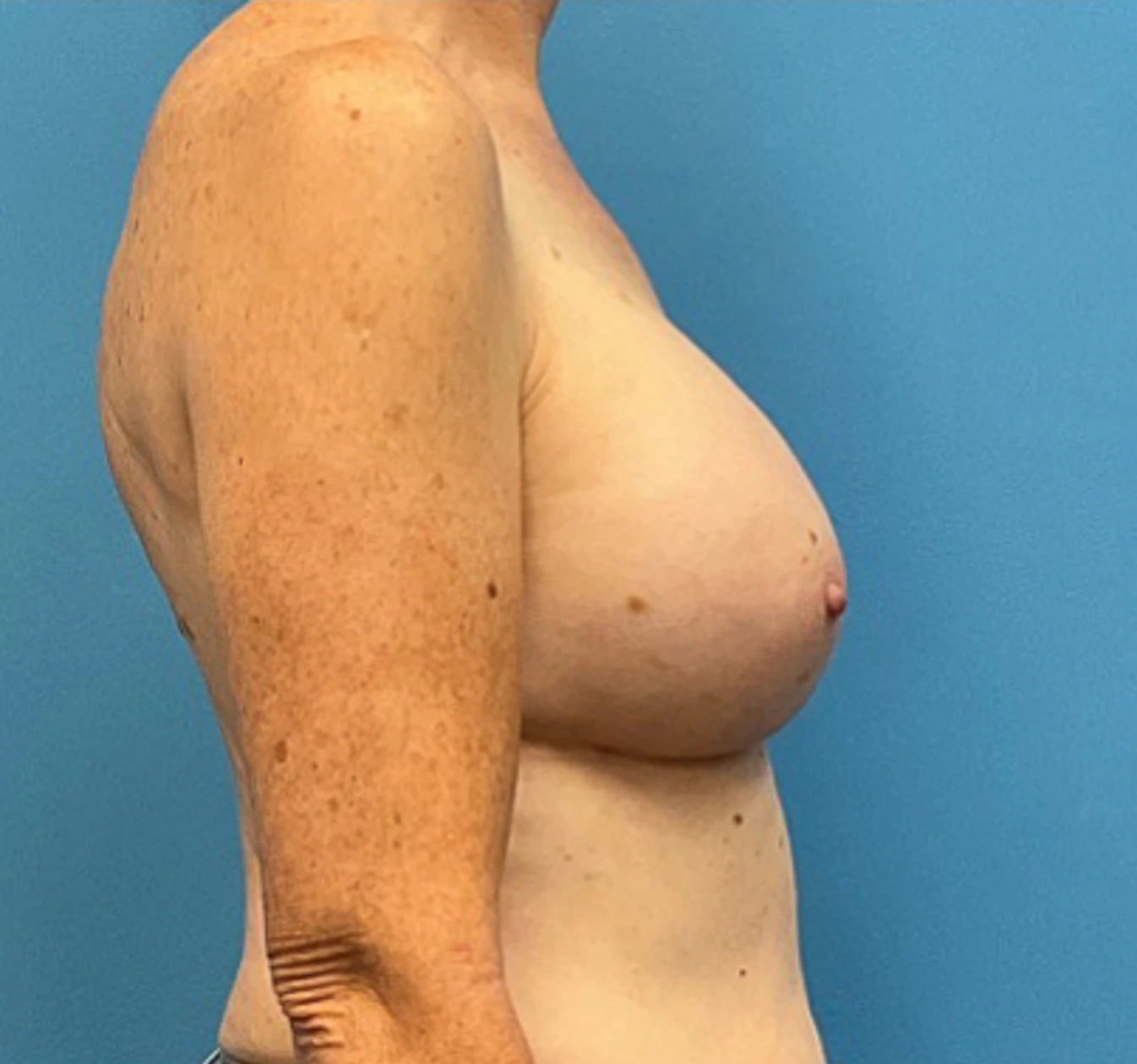 Breast-Augmentation-Case--27374 | After Breast Augmentation 5