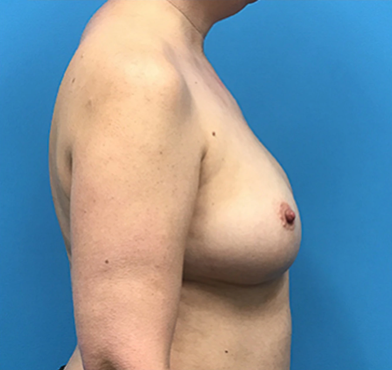 Case--136 | After Breast Reconstruction 3