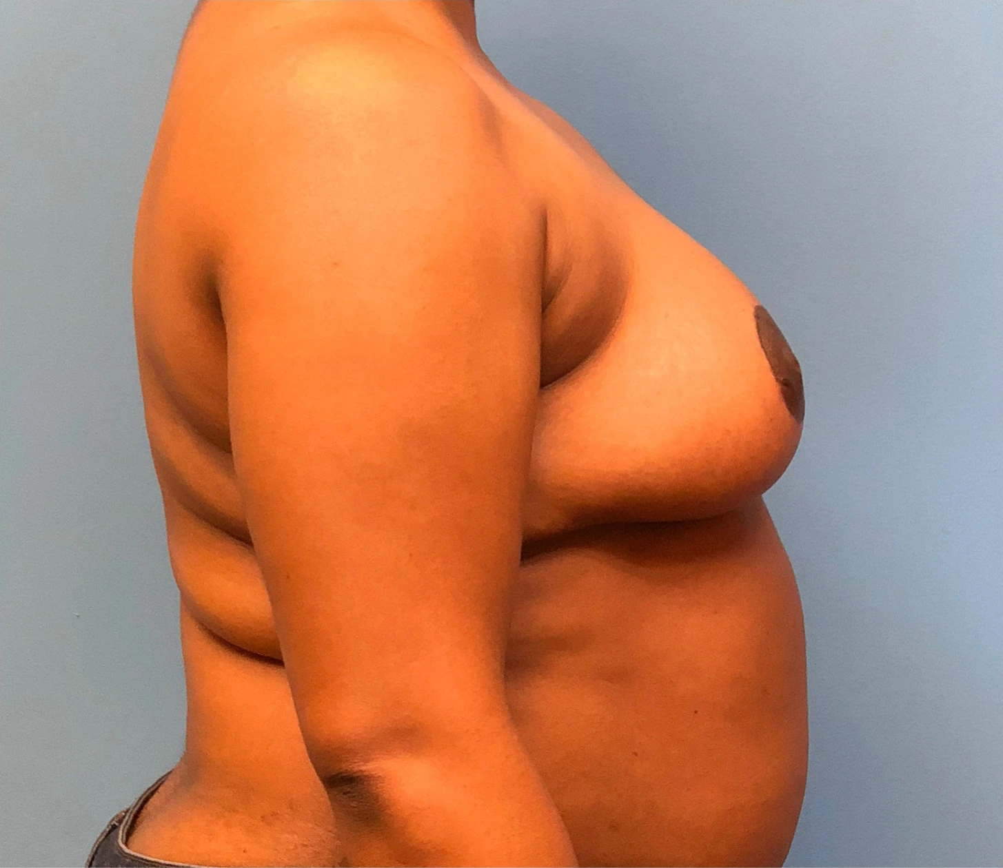 Breast-Reduction-Case--12894 | After Breast Reduction 3