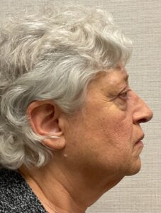 Rhinoplasty-Case--25467 | After Rhinoplasty 2