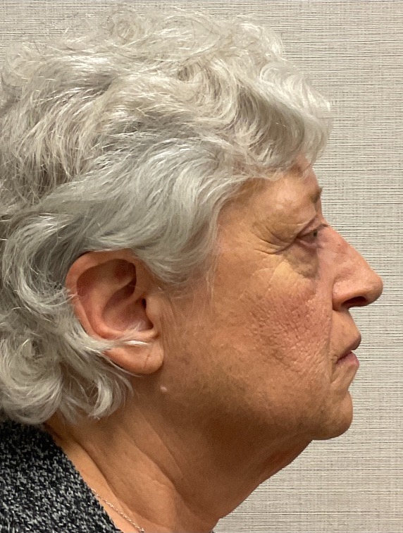 Rhinoplasty-Case--25467 | After Rhinoplasty 2