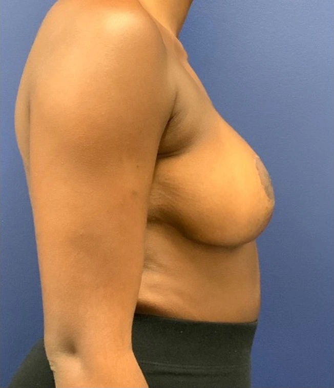 Breast-Reduction-Case--27254 | After Breast Reduction 3