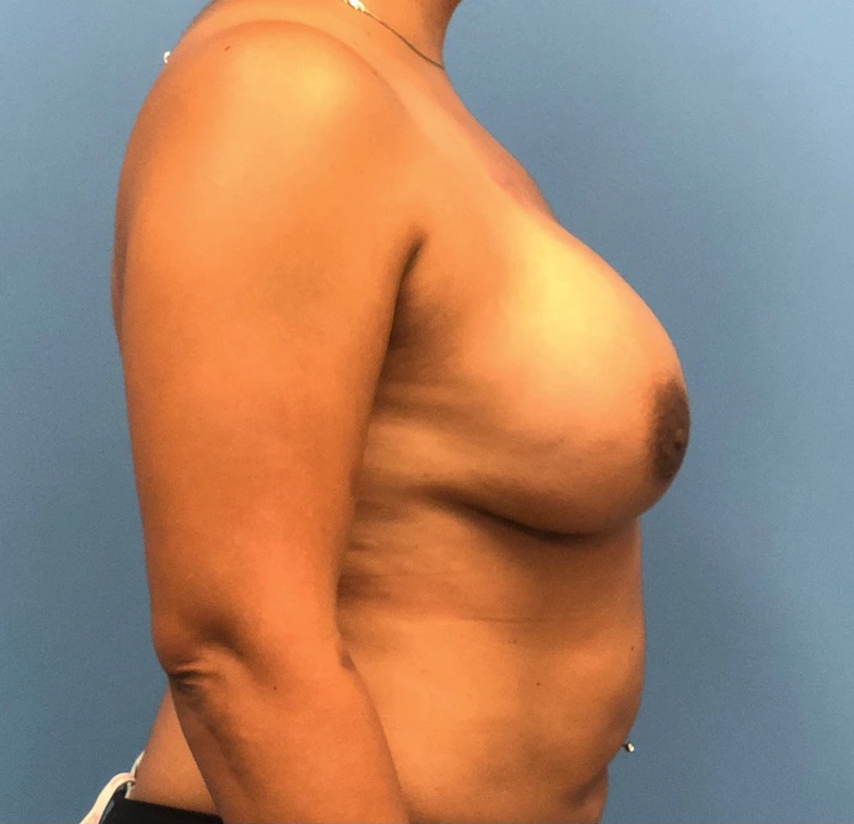 Case--11132 | After Breast Reconstruction 3