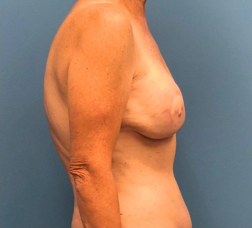 Case--10040 | After Breast Reconstruction 3
