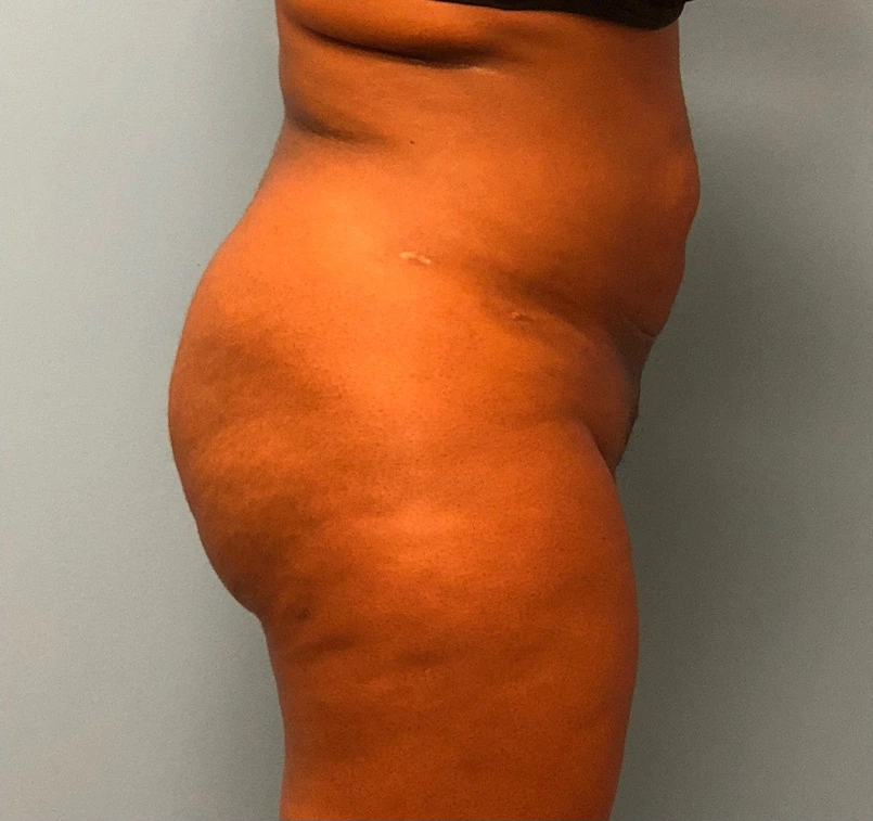 Brazilian-Butt-Lift-Case--13244 | After Brazilian Butt Lift 2