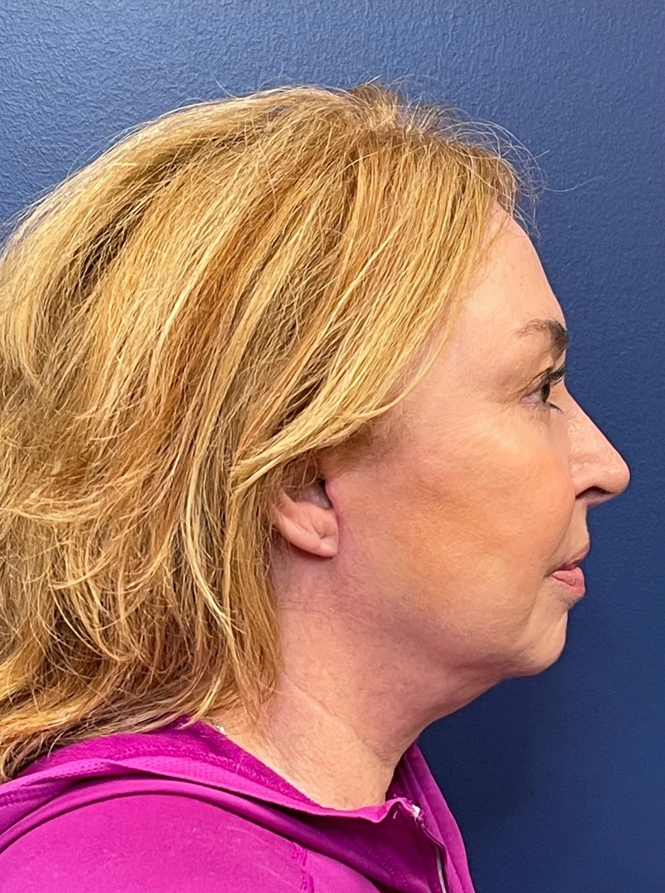 Facelift-Case--22860 | After Facelift 3