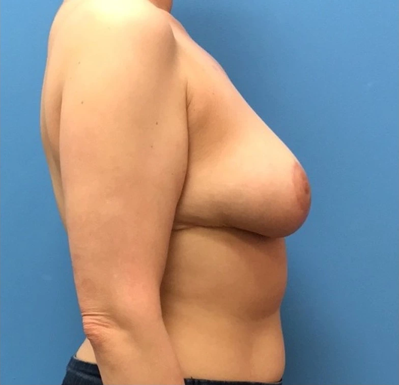 Breast-Reduction-Case--242 | After Breast Reduction 2