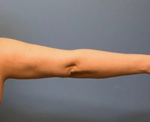 Brachioplasty-Case--78 | After Arm Lift 2