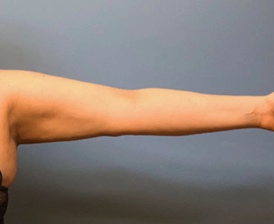 Brachioplasty-Case--78 | After Arm Lift 3