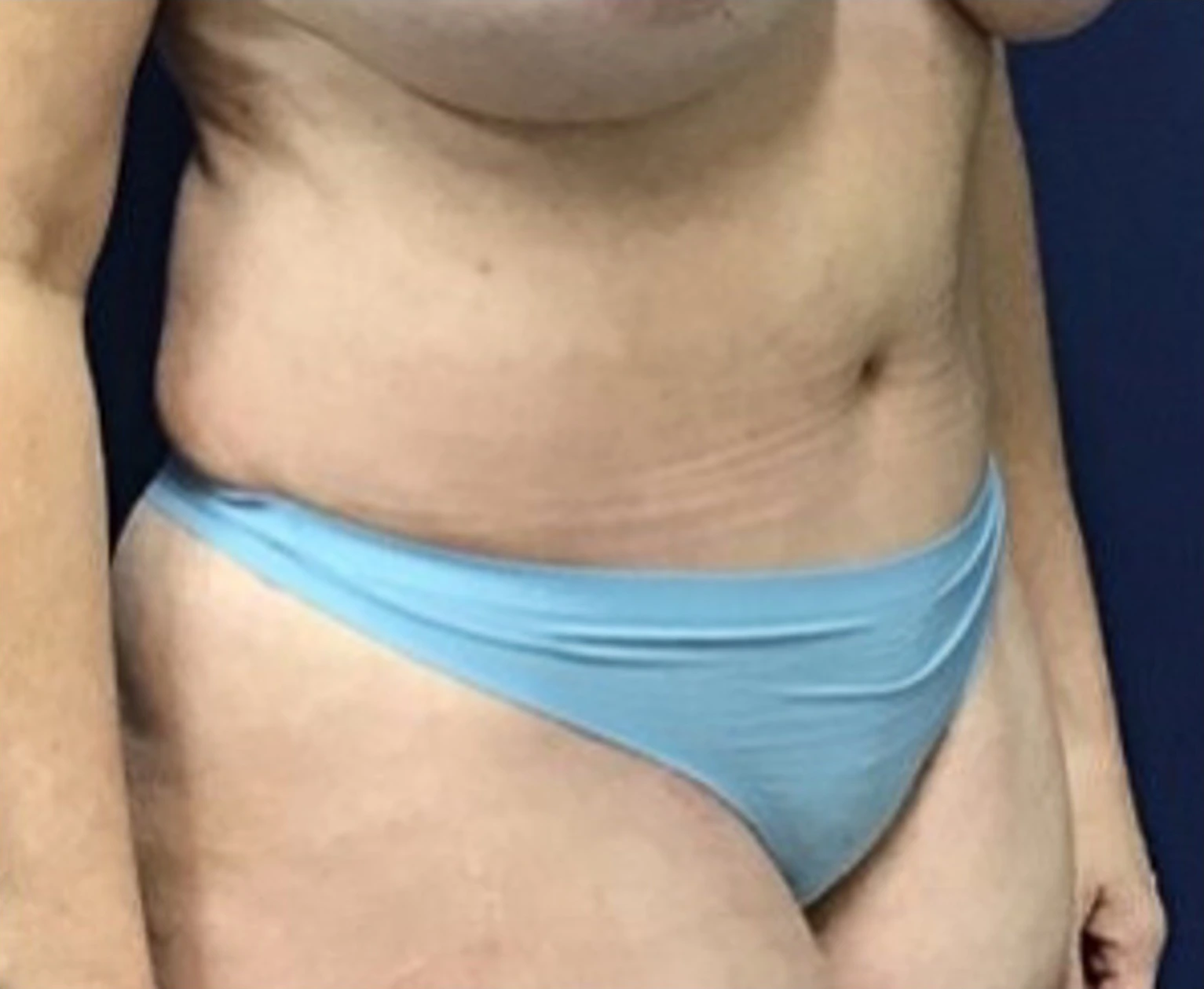 Liposuction-Tummy-Tuck-Case--25682-2 | After Liposuction 4